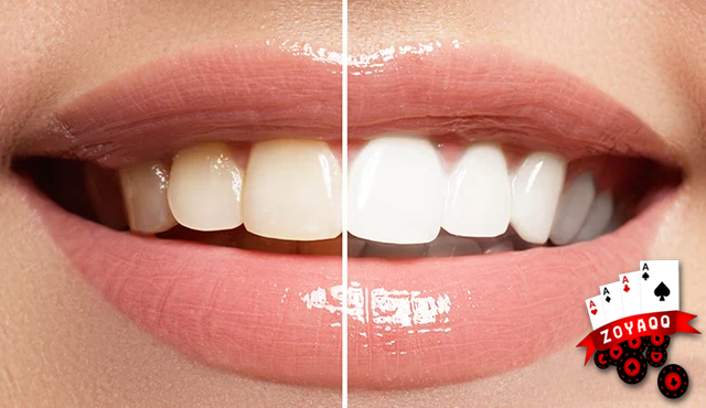 8 Cara Alami Memutihkan Gigi yang Cepat dan Mudah 