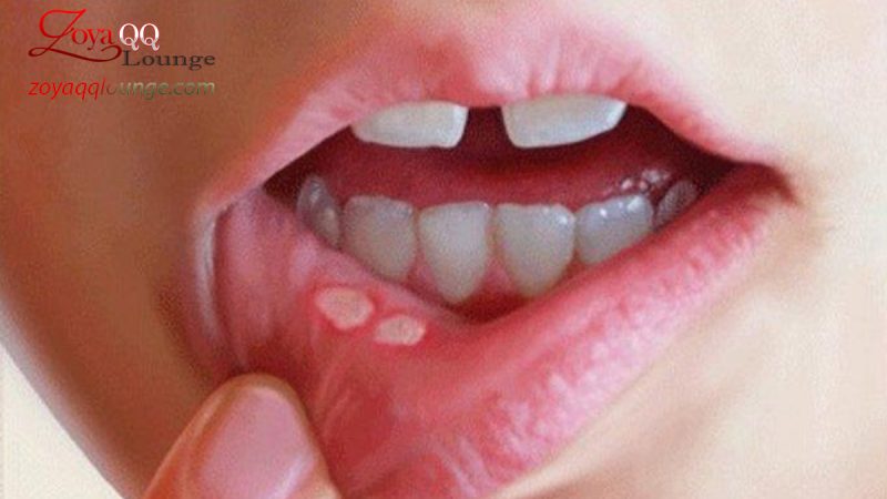 Masalah Gigi dan Mulut yang Mungkin Muncul Akibat Stres