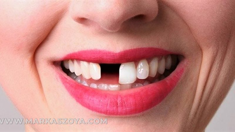 Kenali Penyebab Terjadinya Gigi Gigis pada Anak-anak